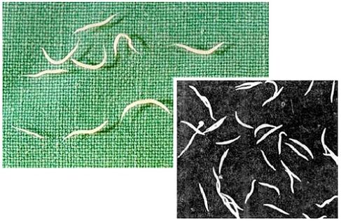 pinworms from the human body